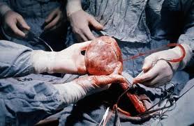 Heart transplant surgery