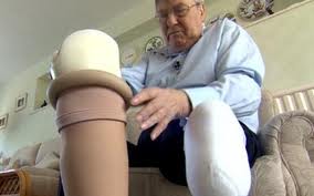 Amputation